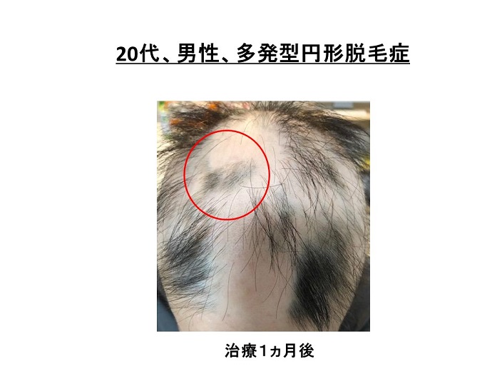 円形脱毛症　病院
